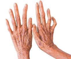 सुदूरपश्चिममा कुष्ठरोगको समस्या यथावत